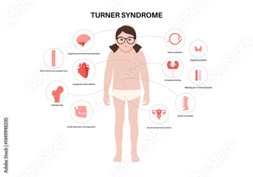 Turner syndrome poster