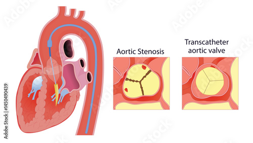 Illustration of Transcatheter Aortic Valve Replacement (TAVR), showing a narrowed aortic valve (aortic stenosis) and its treatment with a transcatheter heart valve to restore normal blood flow.
