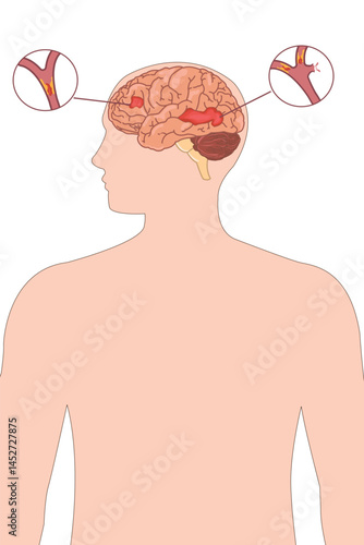 Medical diagram showing blocked and burst artery causing stroke in brain anatomy