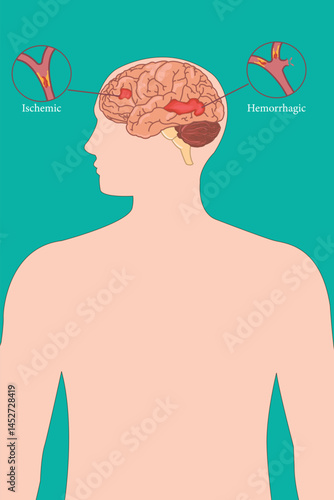 Illustration of ischemic and hemorrhagic stroke in human brain cross-section diagram on green background. eps 10