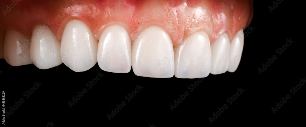 Fototapeta premium ceramic crowns and veneers