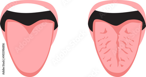 Cartoon illustration showing a close-up comparison between a healthy tongue and a fissured cracked tongue. Educational and medical concept for oral health awareness
