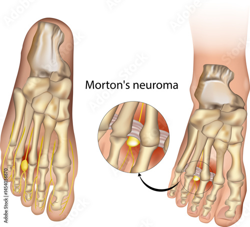 Anatomical Illustration of Morton's Neuroma in the Human Foot. Medical Diagram Showing Nerve Compression in Morton's Neuroma. Detailed Foot Anatomy Highlighting Morton's Neuroma Condition