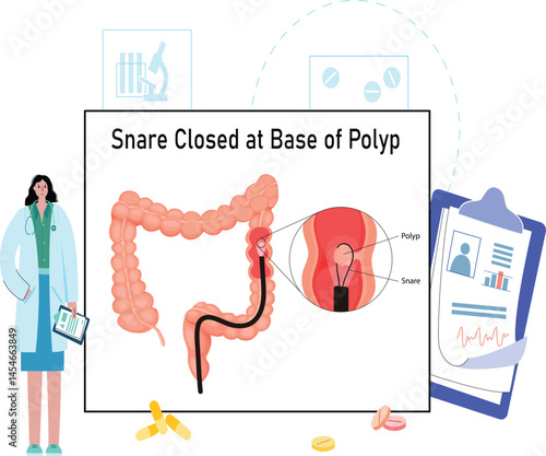 Colon Polyp Removal Medical Illustration – Vector Graphic for Healthcare and Educational Use