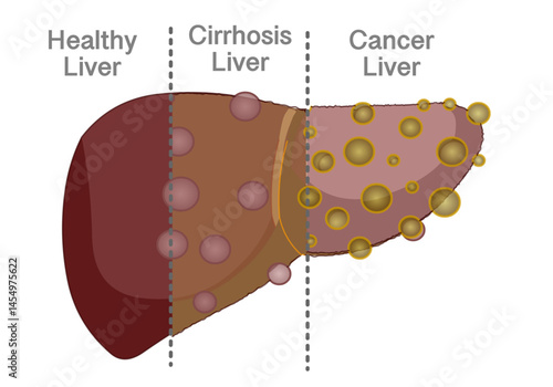 Stages liver cancer, cirrhosis structure, transplant disease steps. Annotated, explanations. Progression, healthy normal liver, fatty fibrosis, ESLD. medical, human organs. Vector illustration