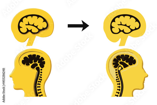 Medical illustration of meningitis causing inflammation in the brain and spinal cord, showing affected areas with clear visual cues medical virus icon set