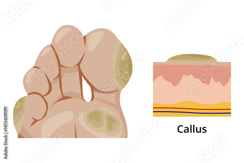 Callus forming on sole of foot and its anatomical structure