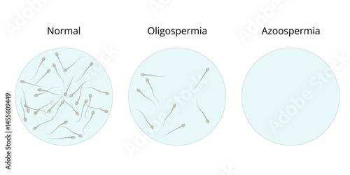 Normal, Oligospermia and Azoospermia Sperm Count Comparison