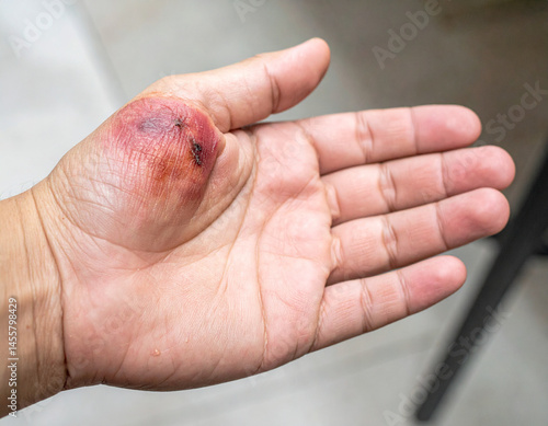 A burn on the hand presents redness and peeling.