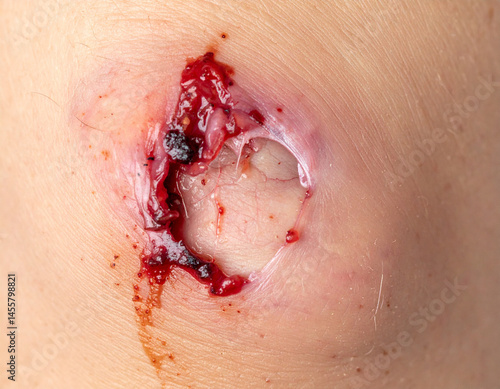 A reopened wound shows disrupted healing.
