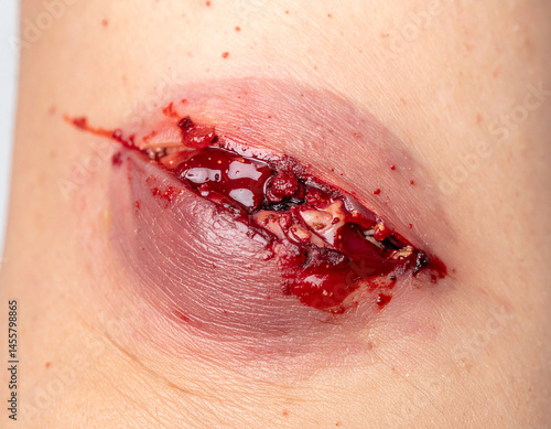 A reopened wound shows disrupted healing.