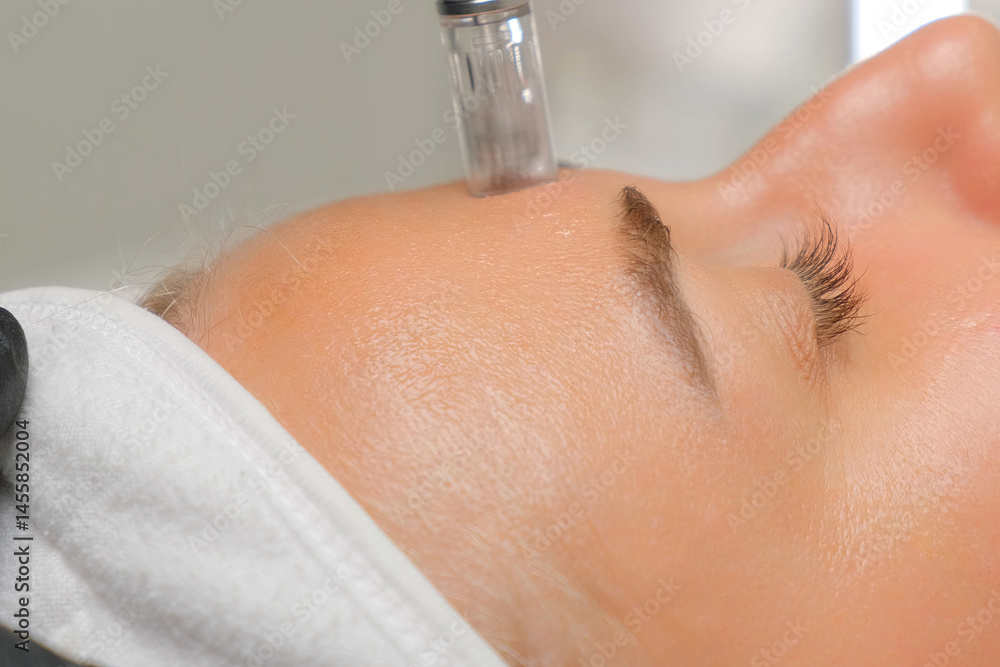 Fototapeta premium Microneedle RF lifting procedure. A cosmetologist performs a facial rejuvenation procedure on a woman. Hardware cosmetology.
