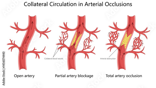 blood flow changes in artery from open flow to partial blockage and total occlusion, highlighting collateral circulation diagram hand drawn schematic raster illustration. Medical science educational