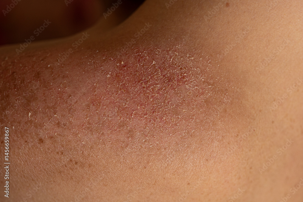 Fototapeta premium closeup sunburn concept, skin peeling on woman's shoulders, unhealthy