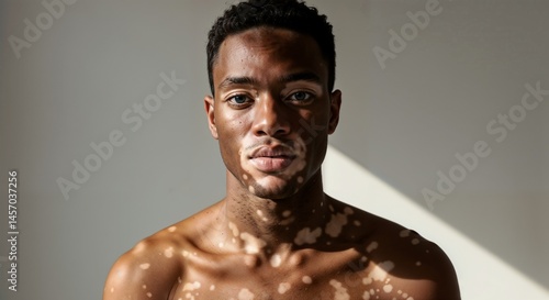 Confident shirtless man with vitiligo looking at camera in sunlight against a light background