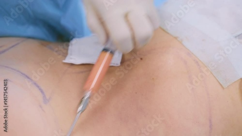 Close-up of a liposuction cannula inserted into a marked area on the patient’s body during a cosmetic surgery procedure.