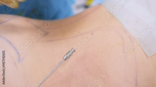 Close-up of a surgeon injecting fat tissue into a marked area on the patient’s body during a fat transfer procedure.