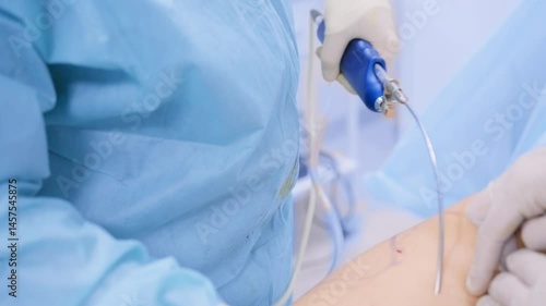 Close-up of surgeons using a cannula to perform liposuction on a marked abdomen in a sterile surgical environment.