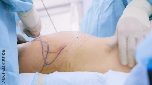 Close-up of surgeons using a cannula to perform liposuction on a marked abdomen in a sterile surgical environment.