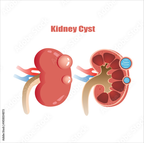 Kidney Cyst