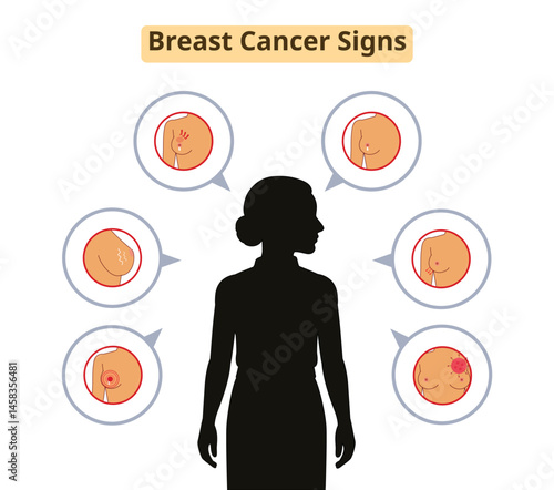 Breast Cancer Signs and Symptoms - Visual Guide to Early Detection
