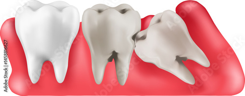 Illustration depicting a partially impacted wisdom tooth The image shows three molars, with the rearmost tooth positioned horizontally and pressing against