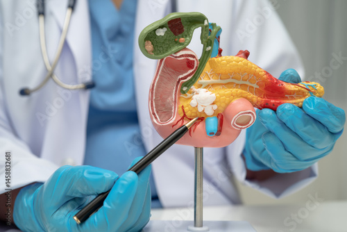 Pancreatitis, pancreatic cancer, Asian doctor with pancreas, gallbladder and bile duct human anatomy model at hospital.