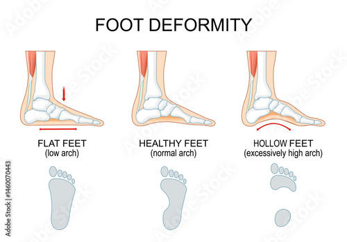 Foot deformity. Healthy feet, Flat feet and hollow