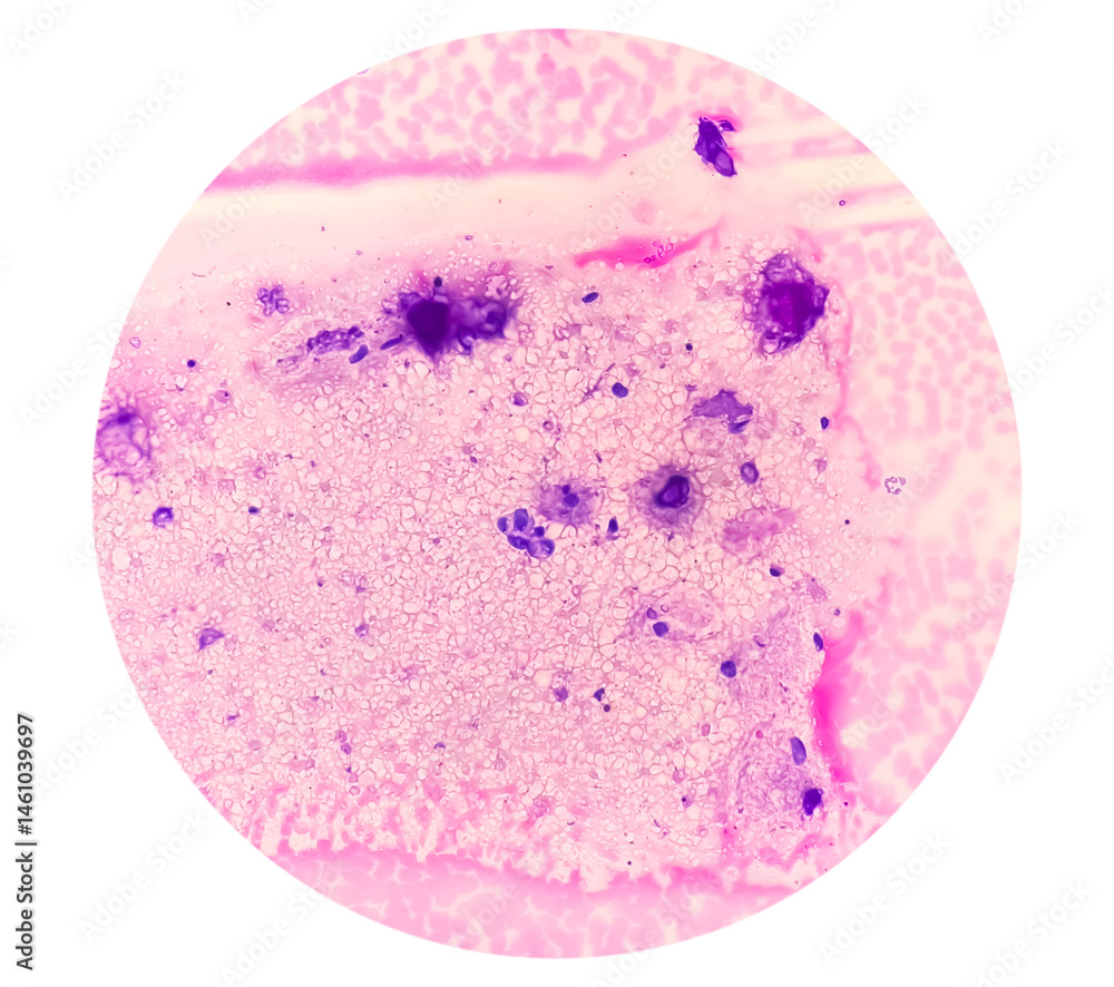 Suspicious cells with atypia in nipple discharge cytology, may indicate a higher risk of underlying breast pathology, including cancer. Suspicious cells with atypia in nipple discharge cytology, may indicate a higher risk of underlying breast pathology, including cancer.