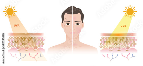 Comparison of damaged man face from UVA and UVB rays illustration. UVA resulting in freckles, aging, wrinkle, dark spots. UVB resulting in a burn, inflammation, red spots. Men skin care concept.