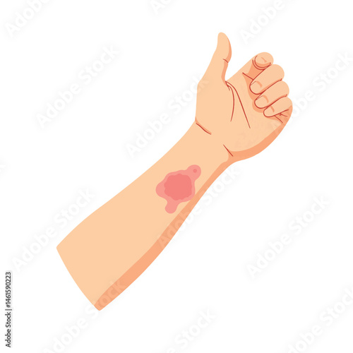 Illustration of itchy rash on forearm, medical education