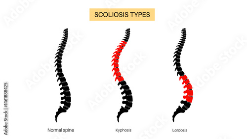 Scoliosis medical poster