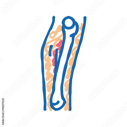 hairline fracture icon doodle illustration