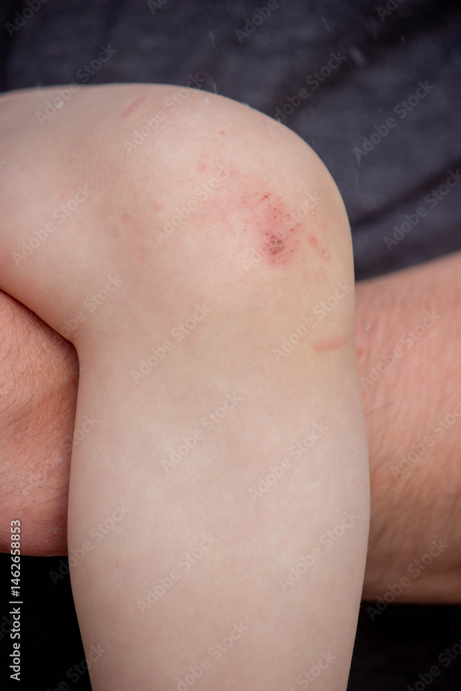 Scratches on a child's leg. small child. Scratches on a child's leg. small child.