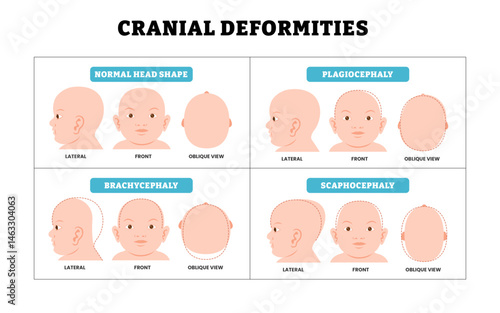 Different types of cranial deformities baby infant child newborn defect birth, educational medical poster design healthcare, plagiocephaly, brachycephaly, scaphocephaly with side, front, lateral view.
