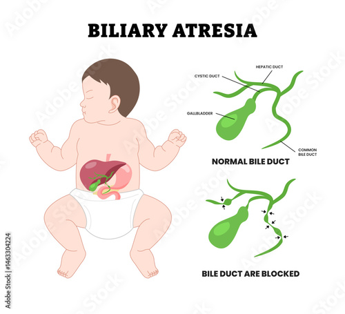 Baby Biliary atresia bile duct blocked, educational medical poster design healthcare, blocked Primary acute choledochal cyst stone obstructive damage bilirubin level acid. Extrahepatic ductopenia.