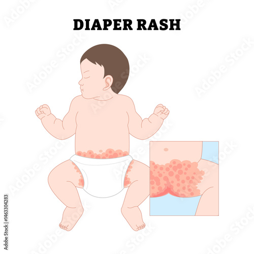Baby Diaper Rash, educational medical poster design healthcare, labeled diaper dermatitis, skin irritation, Skin rash allergy hives, cloth staph heat red. Home chafe sore leg bleed illustration.