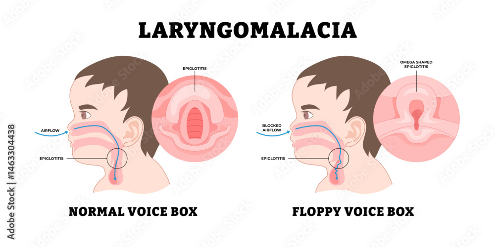 Fototapeta premium Baby Laryngomalacia, educational medical poster design healthcare, labeled noisy breathing in babies, soften or floppy abnormality larynx (voice box) tissue vocal cords, stridor, fall back airways.