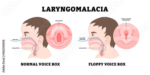 Baby Laryngomalacia, educational medical poster design healthcare, labeled noisy breathing in babies, soften or floppy abnormality larynx (voice box) tissue vocal cords, stridor, fall back airways.