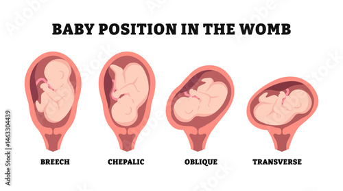 Different types of baby position in the womb during pregnancy, educational medical poster design healthcare, labeled Cephalic, Breech, transverse, Oblique lies, Fetus with umbilical cord and placenta.