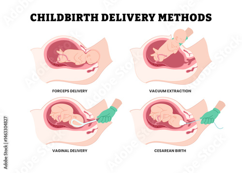 Different types of childbirth delivery methods steps procedure with doctor, educational medical poster design healthcare, labeled forceps delivery, vacuum extraction, vaginal delivery, cesarean birth.