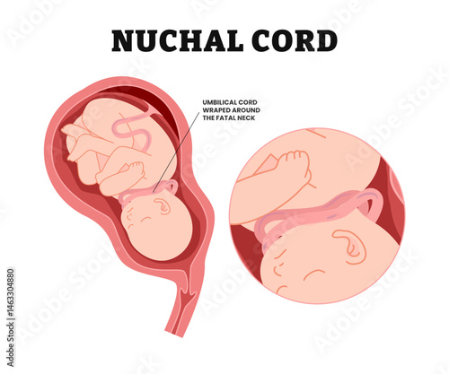 Baby Nuchal Cord, educational medical poster design healthcare, labeled wrapped umbilical cord around fetus neck, c section baby birth fetal neck death Knot test born labor fluid Anemia womb fetus.
