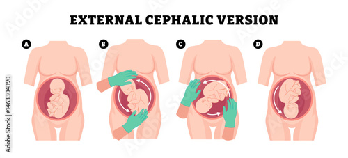 Steps of external cephalic version steps methods procedure with doctor hans, educational medical poster design healthcare, labeled manually turn baby from breech to head-down cephalic position birth.