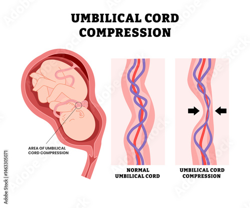 Baby Umbilical Cord Compression, educational medical poster design healthcare, labeled flattened or squeezed umbilical cord, restrict blood flow and oxygen to the fetus.