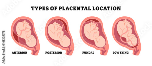 Different types of placental location types, educational medical poster design healthcare, labeled anterior, posterior, fundal, low lying. Baby develops wall of the uterus position.