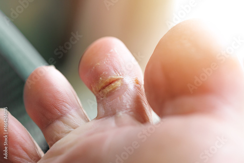 Obraz na płótnie Dry, cracked toe wounds infection wet moist feet skin fungi, Athlete foot tinea