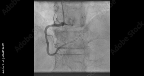 Coronary Angiogram – High-Resolution Medical Imaging of Heart Blood Vessels