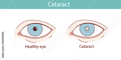cataract eye vector anatomical illustration