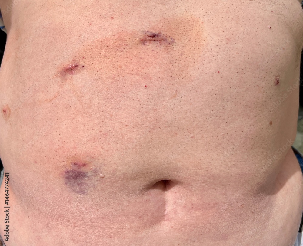 Fototapeta premium Incisions on an adult male that has gone under laparoscopic gallbladder removal surgery