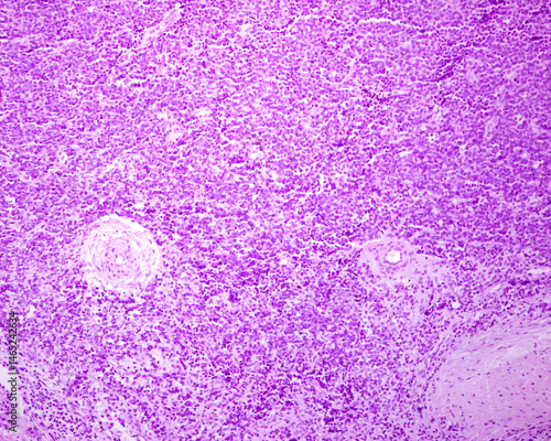 Ewing sarcoma